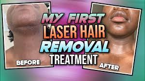 At ideal image, our specialists have customized our laser settings to effectively treat larger areas, meaning a full back hair removal procedure may take just an hour. My First Laser Hair Removal Treatment Ideal Image Review Laser Hair Removal Before After Cost Youtube