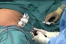 Cand Si De Ce Trebuie Operata Hernia Medlife