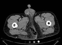 Confirm the patient's name and date of birth. Fournier Gangrene Jetem