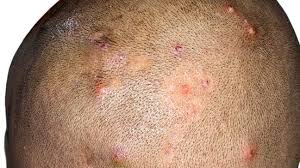 Image result for folliculitis symptoms