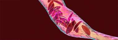 Bei der schweren, homozygoten sichelzellanämie sind beide gene defekt. Sichelzellanamie Neuer Inhibitor Setzt Am Defekten Hamoglobin An Medical Tribune