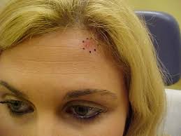 Skin cancer is on the rise around the world. I Was Only 28 When I Was Diagnosed With Skin Cancer Here S What I Want You To Know Huffpost Life