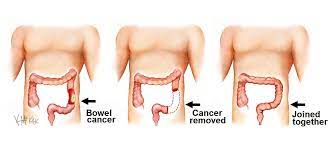 Everyone should consider checking their stools regularly to look out for any of the four key warning signs. Bowel Cancer Colorectal Surgeons Sydney