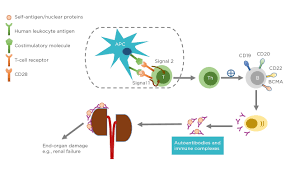 Lupus erythematosus is a collection of autoimmune diseases in which the human immune system becomes hyperactive and attacks healthy tissues. Expanding The Role Of Car T Cell Therapy To Systemic Lupus Erythematosus European Medical Journal