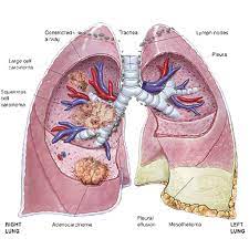 Pyrophoric materials can have other hazardous qualities, including: Mesothelioma Asbestos Cancer Apps Op Google Play