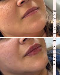 Sientes que a tus labios les falta definición e hidratación? ¡Este es el  resultado que buscaba mi linda paciente! 🫶 ¿Qué detallito se quieren hacer  ustedes? 💉 👩‍⚕️ Atiendo en Machalí y