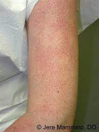 Soothe Keratosis Pilaris Chicken Skin With African Black Soap And Coconut Oil Keratosis Pilaris Skin Care Acne Splotchy Skin
