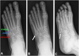 An avulsion fracture to your foot or ankle may require a cast or walking boot. Fifth Metatarsal Fracture Wikem
