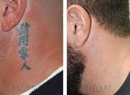 Dreieckiges tattoos tatuajes tattoos feather tattoos tatoos form tattoo shape tattoo color tattoo big black grand noir. Tattoo Removal