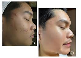 Something new is in…🤭 So eager to share that soon our shelves will be  stocked with this new product that is your hyperpigmentation's worst  nightmare After acne is cleared, we can often