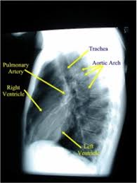 Normal chest x ray anatomy. X Ray Atlas Chest X Ray Glowm