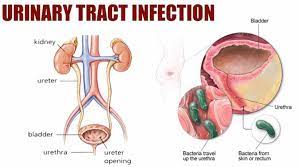 Urinary tract infection causes, symptoms, diagnosis, prevention & treatment