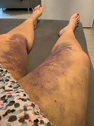Lipodem Op Bzw Liposuktion Ein Erfahrungsbericht