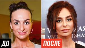 неудачные пластические операции российских звезд фото до и после Zvezdy Do I Posle Plastiki Znamenitosti Kotoryh Ne Uznat Na Staryh Foto Youtube