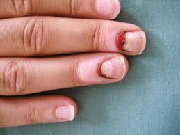 Image result for Akutní zánět nehtového lůžka