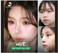 THAY ĐỔI DÁNG MŨI THẤP MẤT LỘC