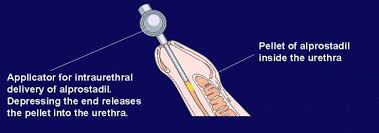 Image result for Intraurethral Alprostadil