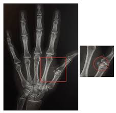 In this, the finger under test is allowed to flex while blocking the action of the flexor digitorum profundus (fdp) tendon through prevention of flexion of distal interphalangeal (dip) joints of the other two fingers. Fun Facts About Your Hands Melbourne Hand Rehab