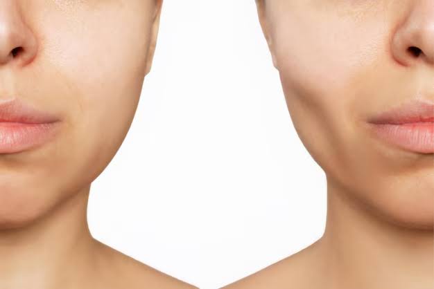 Buccal Fat Removal: The Secret to a Snatched Face or a Risky Trend? – Halo  Beverly Hills