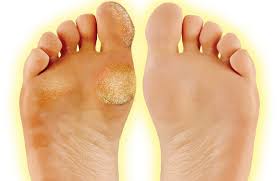 Like apple cider vinegar, hydrogen peroxide is an effective antifungal.7 x trustworthy source pubmed central journal archive from the u.s. How To Get Rid Of Calluses On Feet Neybg