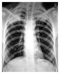 The pain typically develops as the. Pancoast S Syndrome Due To Fungal Abscess In The Apex Of Lung In An Immunocompetent Individual A Case Report And Review Of The Literature