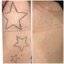 This tattoo removal will usher you through the process, providing info on types of removal, the risks, the costs, and even products that can help things go a lot smoother. Laser Tattoo Removal Brisbane Redlands Injex Clinics