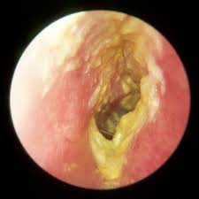 Image result for Acute Otitis Externa