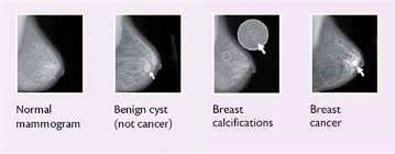 Image result for Mammogram Interpretation