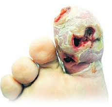 Mengapa luka bersalin lambat sembuh. Cara Sembuhkan Luka Kencing Manis Dengan Cepat