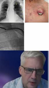 🎙️NEW #TCT2024 Interview 💫Dr Marc Dweck joins us to discuss findings from  the EVOLVED trial. 📽️Watch in full here👉 https://ow.ly/VzhO50TWCpf  📊Early intervention in pts with asymptomatic aortic stenosis did not  impact the