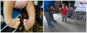 Most of the time, it is not associated with other problems. Before And After Clubfoot Treatment Samsoni S Success Story Miraclefeet