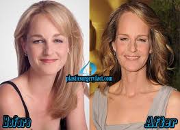 One hollywood actor who has come to the spotlight is hellen hunt after her fans in the bbc drama world on fire questioned her younger looks . Helen Hunt Plastic Surgery Before And After Photos Plastic Surgery Facts