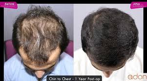 Bald spots are increasingly evident. Prp Hair Treatment There Are Many Hair Treatments By Hair Education Medium