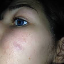 Lumps on neck secrets see your vet quickly if you are worried about a lump. I Need Halo W My Face I Have A Hard Painful Lump Under My Skin On My Face That Little Bump Is Where It S At It S Actually Darker Almost Like A