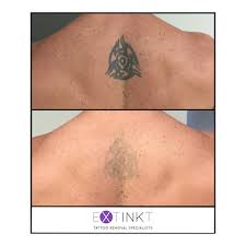 This treatment is recommended for someone who wants new work in place of their old tattoo. Before After Tattoo Removal Results Laser Tattoo Removal Specialists