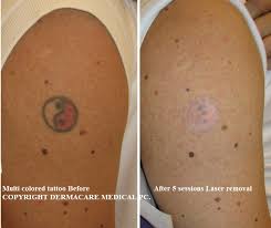 Here are scarcely any means for expelling a lasting tattoo utilizing lemon squeeze and salt. Laser Tattoo Removal New York