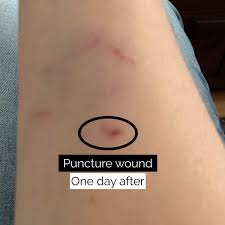 Image result for Cat Bite