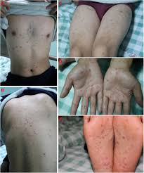 Image result for Varicella zoster on human skin