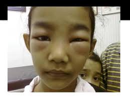 Penyakit ini berlaku apabila buah pinggang. Dr Siti Sarah Aishah Suhaidi On Twitter Ibu Doktor Anak Saya Ni Dah Seminggu Muka Bengkak Kaki Dia Pun Bengkak Kenape Ye Doktor Dr Kencing Ada Berbuih X Ibu Ada Berbuih Juga Dr Tanda2 Seperti Kena Penyakit