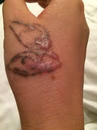 Keloids are raised scars that can sometimes form around piercings or tattoos. Is My Tattoo Removal Scarring Photos