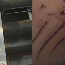 Criança fica ferida após falha em escada rolante no Busca Busca em São José