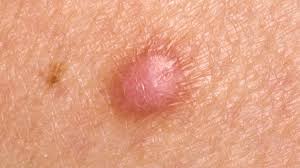 Unfortunately, the condition is an annoying, but however, if you notice whiteheads, bumps, cysts or pimples on your genitalia, immediately book an appointment to see your doctor rather than stressing. What Is A Skin Lump Symptoms Causes Diagnosis Treatment And Prevention Everyday Health