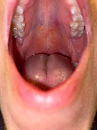 Image result for Physical injury red spots roof of mouth