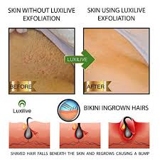 You can also apply a warm compress to the area to soften the skin and allow the hair to come out. Luxilive Exfoliator Brush Ingrown Hair Stainless Steel