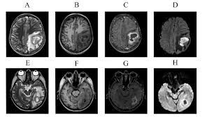 Since a contrast agent is used, there is the risk of an allergic reaction that could lead to. Scielo Brasil Inflammatory Lesions And Brain Tumors Is It Possible To Differentiate Them Based On Texture Features In Magnetic Resonance Imaging Inflammatory Lesions And Brain Tumors Is It Possible To