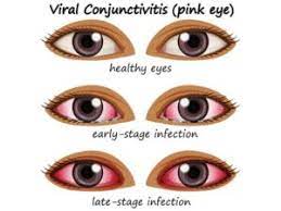 Pink Eye - Baton Rouge Parents