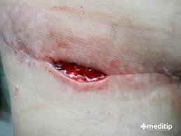 Check spelling or type a new query. Dehiscencia De Heridas Abertura De La Incision Quirurgica Meditip