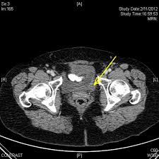 Your appointment is in radiology. Abdominal Ct Scan With Contrast Yellow Arrow Showing A 16 Mm Tumor In Download Scientific Diagram