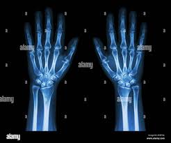 Image result for Wrist XRay
