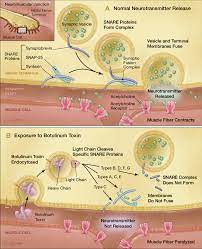 Medical and public health management. Mechanism Of Action Of Botulinum Toxin Download Scientific Diagram